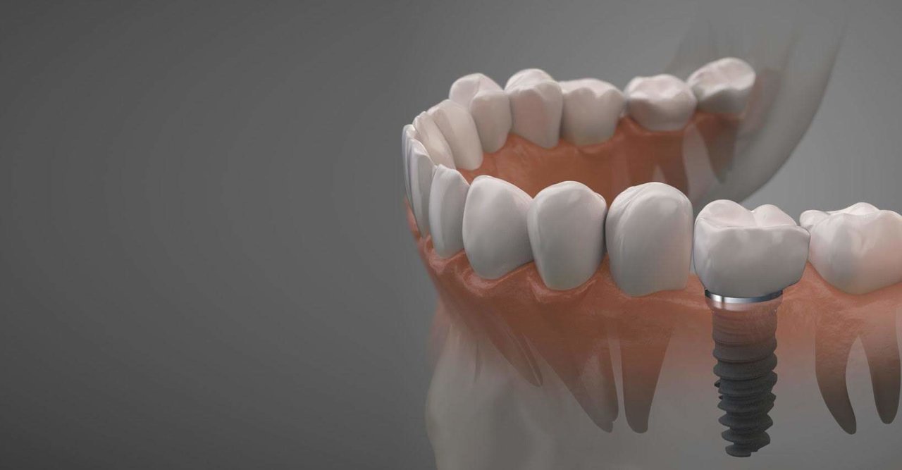 Tipos de implantes dentales y en qué casos se necesita cada uno.