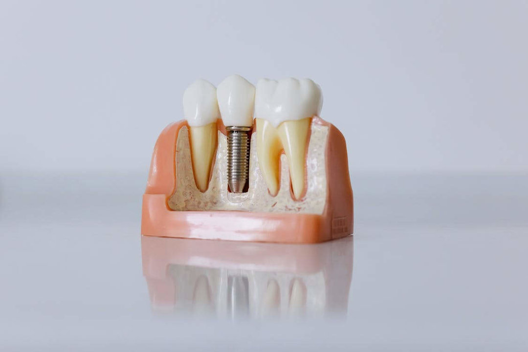 La historia y el futuro de los implantes dentales
