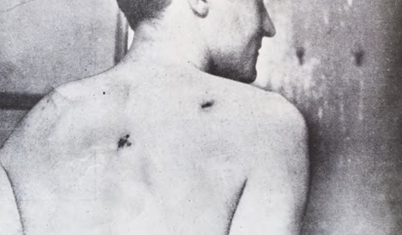 Escarificaciones en la espalda del agente “Louis Chabrat” que contenían los bacilos infecciosos. Su verdadero nombre era Witolds Jedlinski o Jelinski, delincuente habitual francés y actor.