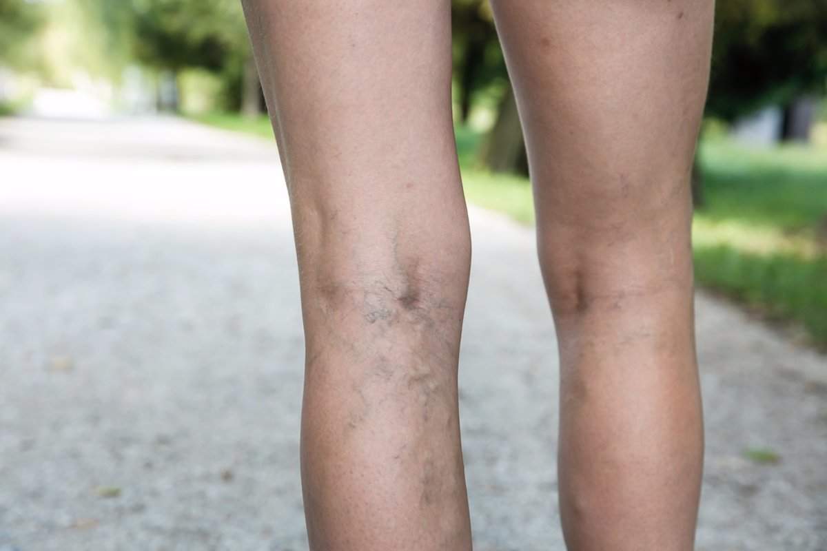 7 Remedios caseros efectivos para eliminar las varices.