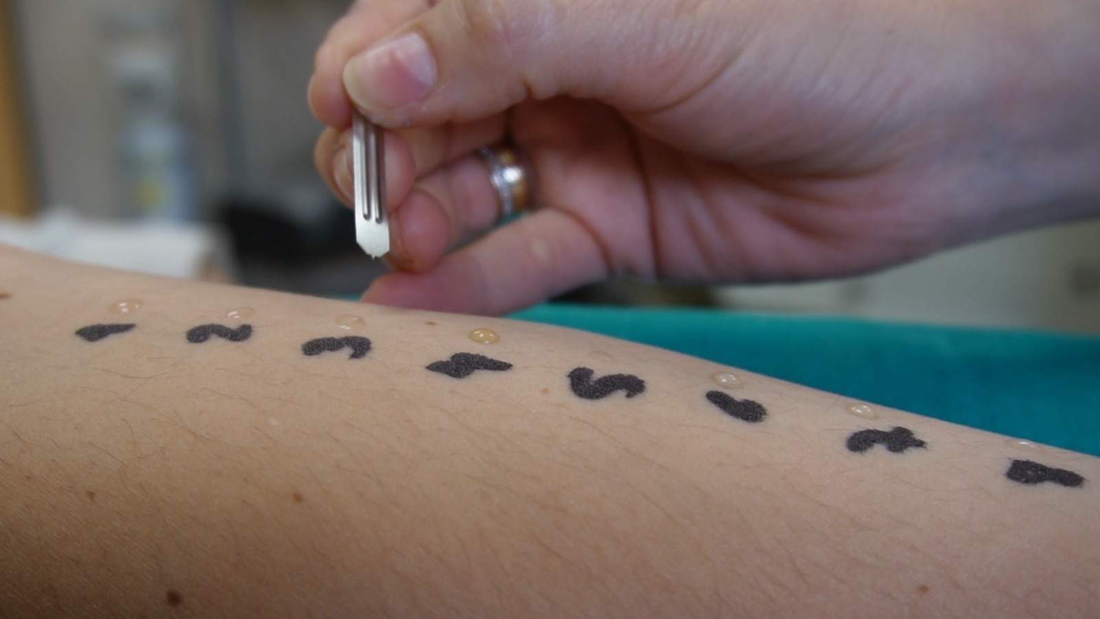 Imagen de recurso de un paciente sometido a una prueba de alergias. Foto: Hospital Universitario Virgen Macarena